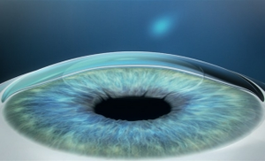 smile surgery results